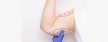What You Need to Know About Arm Lift Surgery? What You Need to Know About Arm Lift Surgery?