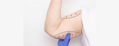 What You Need to Know About Arm Lift Surgery?