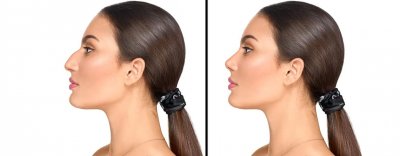 What Causes a Droopy Nose? What Causes a Droopy Nose?
