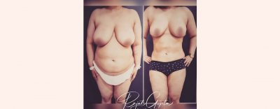 Tips to Maintain Better Results After Liposuction Tips to Maintain Better Results After Liposuction