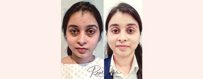 Getting Double Eyelids: Is Surgery Safe and Necessary? Getting Double Eyelids: Is Surgery Safe and Necessary?
